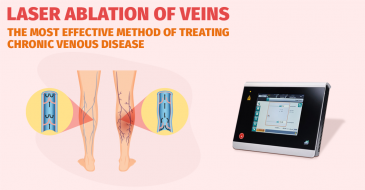 Laser ablation of veins