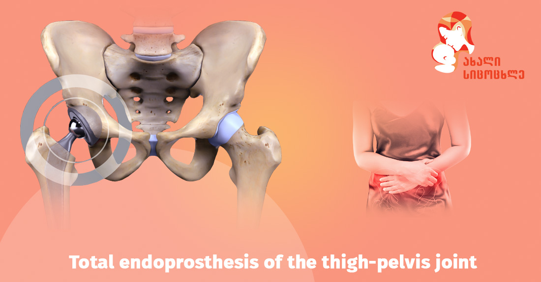  Replacement of a fractured joint with an implant - endoprosthesis