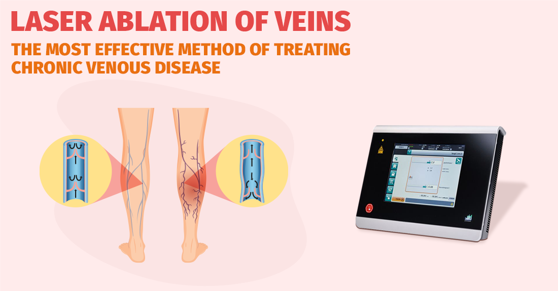 Laser ablation of veins